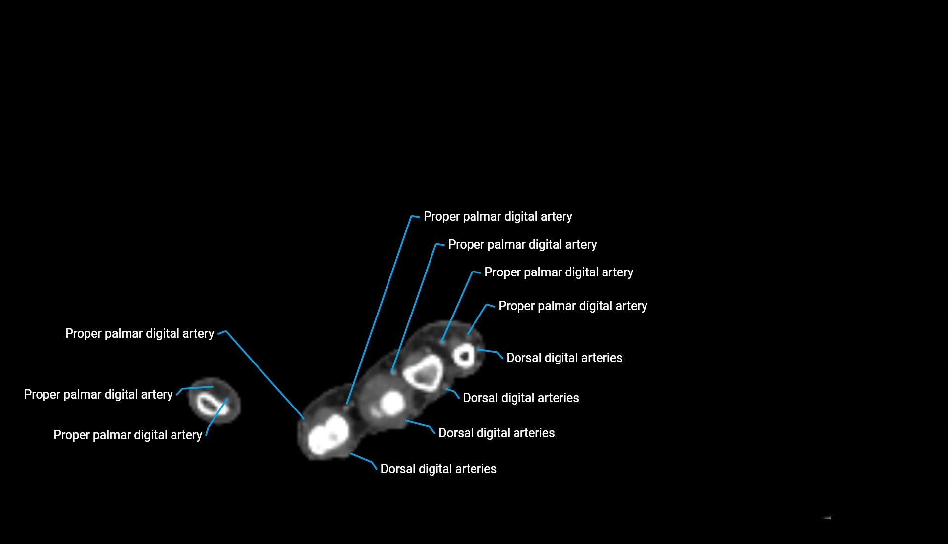 CTA upper limb axial cross sectional anatomy labelled image 43 (2).webp